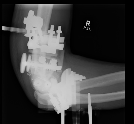 Compass Hinge Lateral Xray